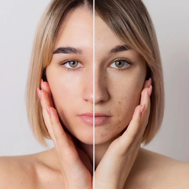 Skincare Treatments, Chemical Peel